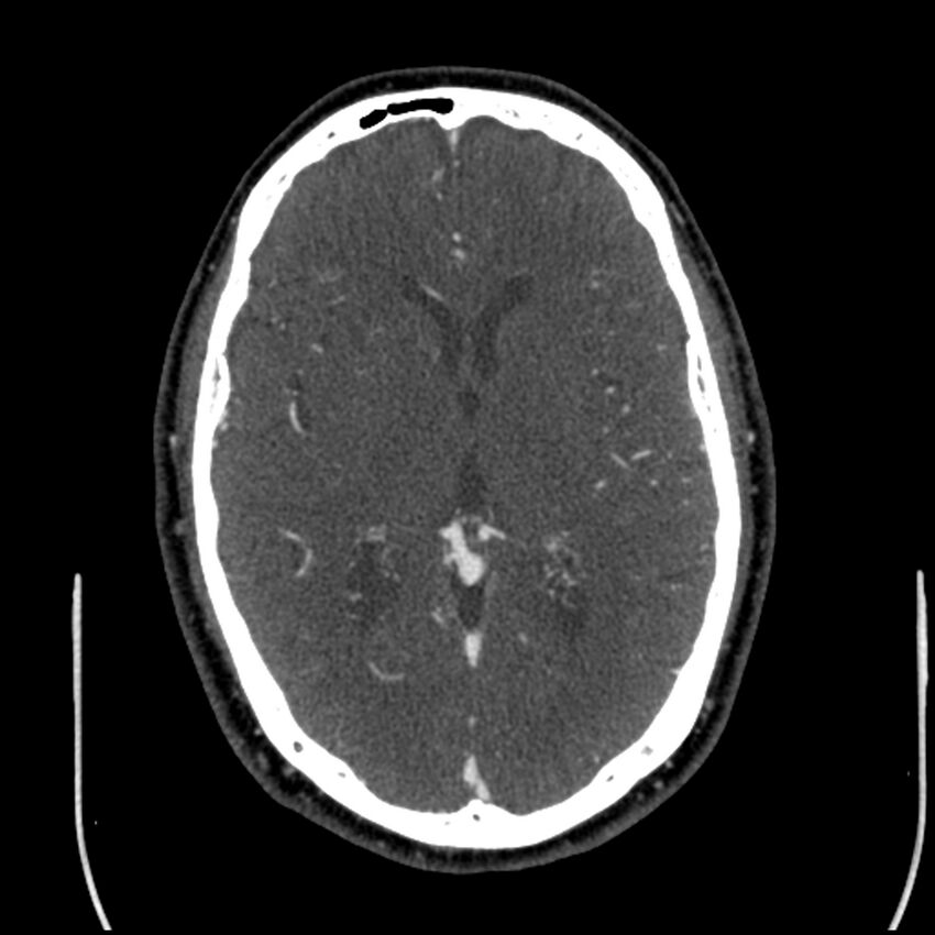 Acute A3 occlusion with ACA ischemic penumbra (CT perfusion) (Radiopaedia 72036-82527 Axial C+ arterial phase thins 68).jpg