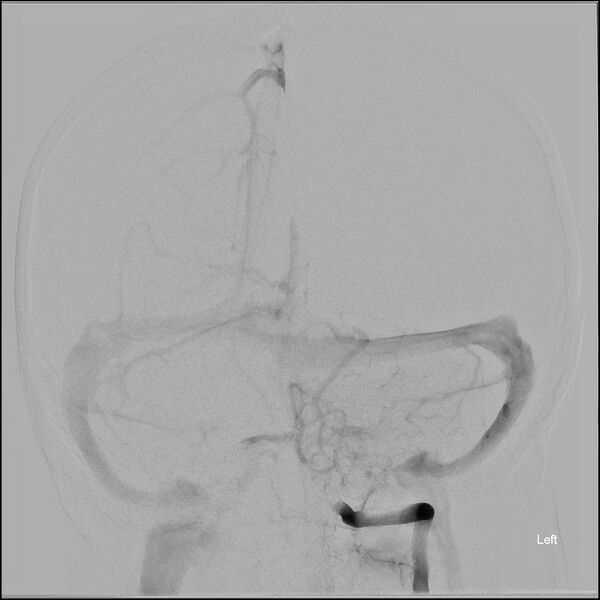 File:Acute P1 occlusion with PCA ischemia penumbra (CT perfusion) (Radiopaedia 72084-82589 Pre ECR frontal - Left VA injection 13).jpg