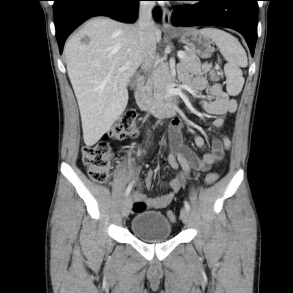 File:Acute appendicitis (Radiopaedia 27049-27227 Coronal C+ portal venous phase 24).jpg