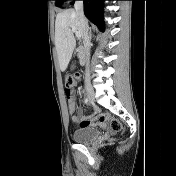 File:Acute appendicitis (Radiopaedia 27049-27227 Sagittal C+ portal venous phase 34).jpg