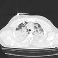Acute aspiration pneumonitis (Radiopaedia 33605-34703 Axial lung window 27).jpg