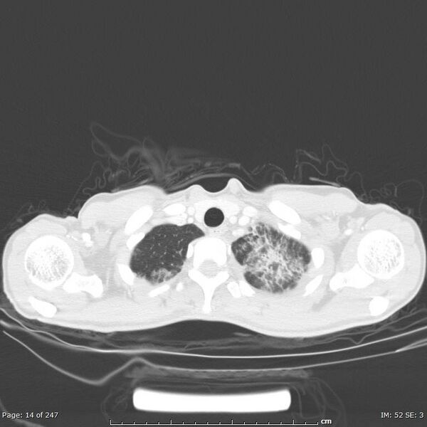 File:Acute eosinophilic pneumonia (Radiopaedia 48211-53073 Axial lung window 5).jpg