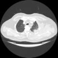 Acute heart failure (CT) (Radiopaedia 79835-93075 Axial lung window 8).png