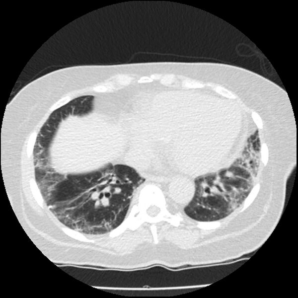 File:Acute interstitial pneumonitis (Radiopaedia 45404-49444 Axial lung window 73).jpg