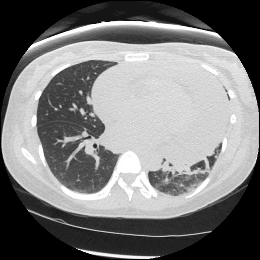 Acute lupus nephritis (Radiopaedia 45832-50107 Axial lung window 55).jpg
