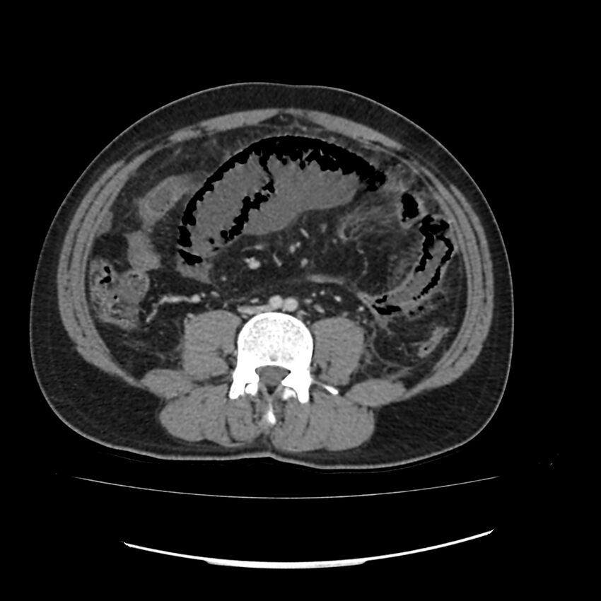 Acute mesenteric ischemia - superior mesenteric artery thrombosis (Radiopaedia 73947-84776 Axial C+ portal venous phase 92).jpg