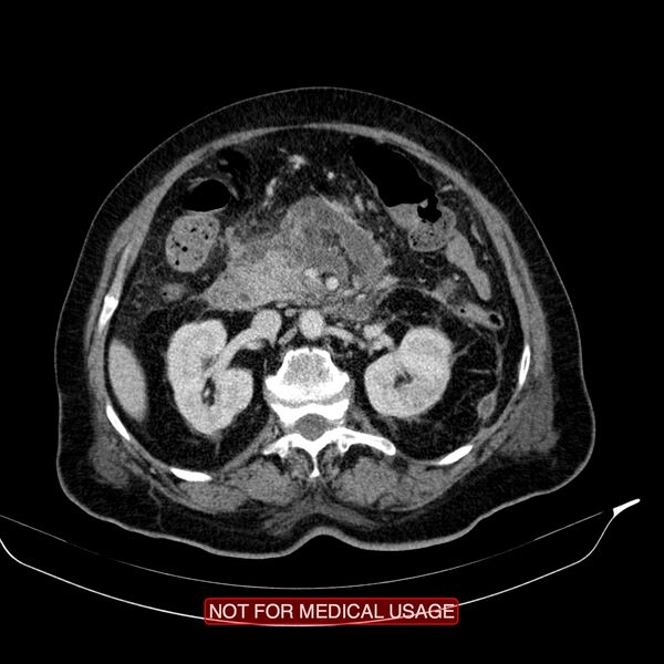 File:Acute pancreatitis with infected necrosis (Radiopaedia 26454-26585 Axial C+ portal venous phase 10).jpg