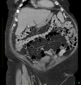 Acute renal failure post IV contrast injection- CT findings (Radiopaedia 47815-52559 Coronal C+ portal venous phase 2).jpg