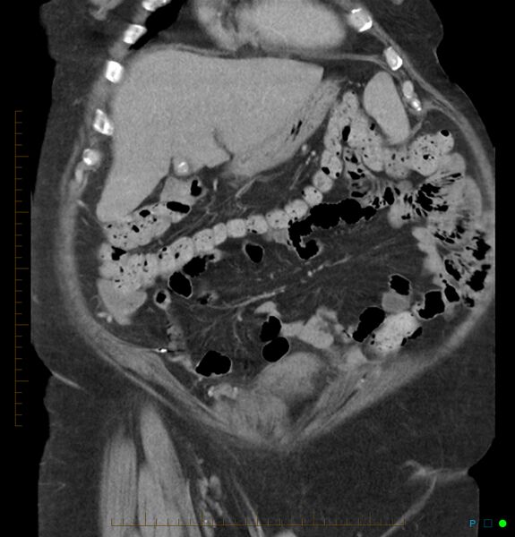 File:Acute renal failure post IV contrast injection- CT findings (Radiopaedia 47815-52559 Coronal C+ portal venous phase 2).jpg