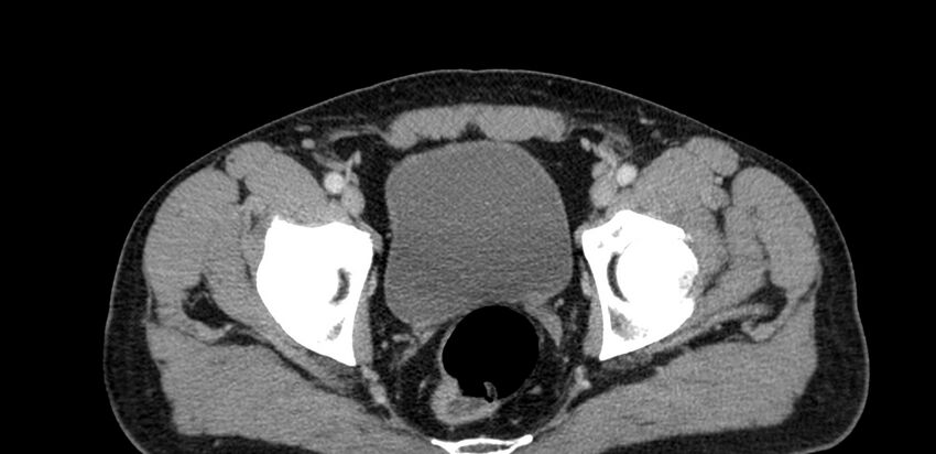 Acute sigmoid colon diverticulitis (Radiopaedia 55507-61976 Axial C+ portal venous phase 113).jpg