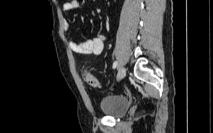 Acute sigmoid colon diverticulitis (Radiopaedia 55507-61976 Sagittal C+ portal venous phase 40).jpg