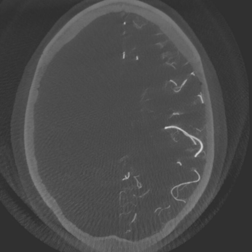 Acute subarachnoid hemorrhage and accessory anterior cerebral artery (Radiopaedia 69231-79010 C 46).jpg