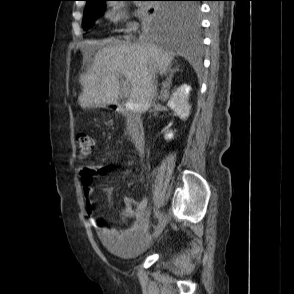 File:Acute tubular necrosis (Radiopaedia 28077-28334 H 35).jpg