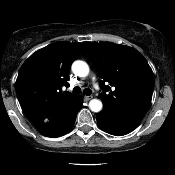 File:Adenocarcinoma of the lung (Radiopaedia 41015-43755 Axial C+ portal venous phase 45).jpg