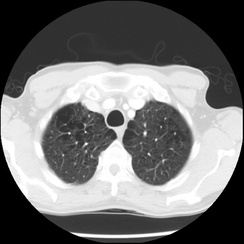 Adenocarcinoma of the lung - micropapillary predominant (Radiopaedia 42446-45563 Axial lung window 13).jpg