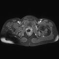 Adenomyoma of the uterus (huge) (Radiopaedia 9870-10438 Axial T1 C+ fat sat 7).jpg