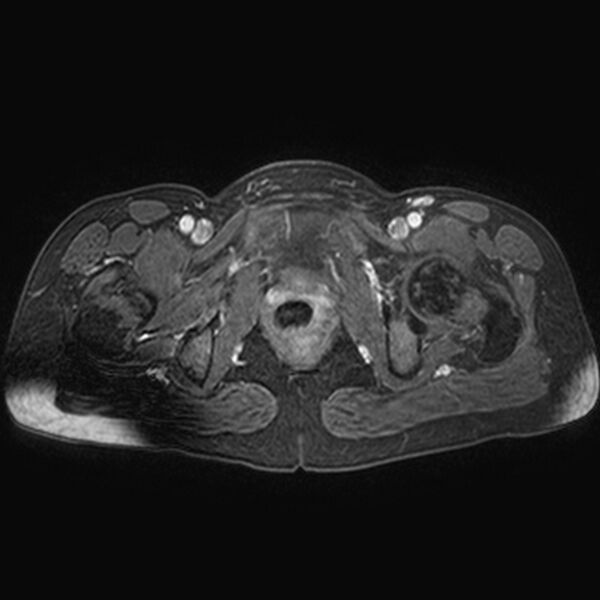 File:Adenomyoma of the uterus (huge) (Radiopaedia 9870-10438 Axial T1 C+ fat sat 7).jpg