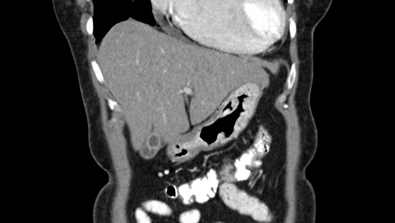 File:Adenomyomatosis of the gallbladder (Radiopaedia 12142-12483 Coronal C+ arterial phase 6).jpg