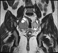 Adenomyosis - ovarian endometriomas (Radiopaedia 67031-76350 Coronal T2 19).jpg