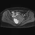 Adenomyosis and endometriotic cysts (Radiopaedia 82300-96367 Axial T1 C+ fat sat 14).jpg