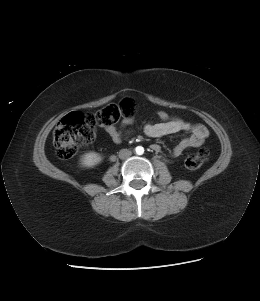 Adrenal cortical carcinoma with IVC invasion and thrombosis (Radiopaedia 34307-35597 Axial C+ arterial phase 49).jpg