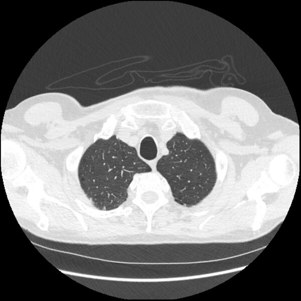 File:Alpha-1-antitrypsin deficiency (Radiopaedia 40993-43722 Axial lung window 24).jpg