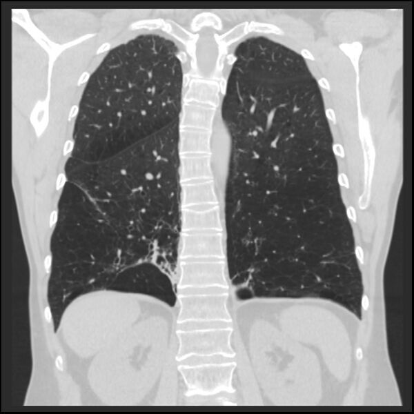 File:Alpha-1-antitrypsin deficiency (Radiopaedia 40993-43722 Coronal lung window 76).jpg