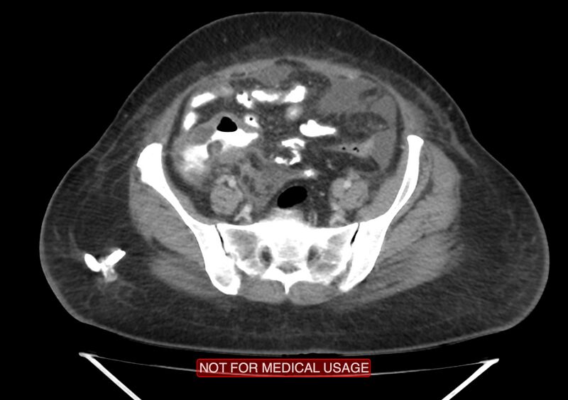 File:Amoebic enterocolitis with liver abscess (Radiopaedia 35100-36609 A 63).jpg
