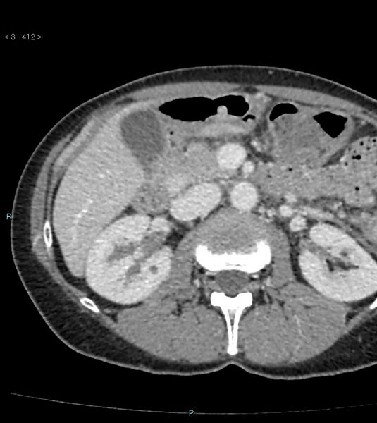 File:Ampulla of Vater metastasis (Radiopaedia 27820-28065 A 16).jpg