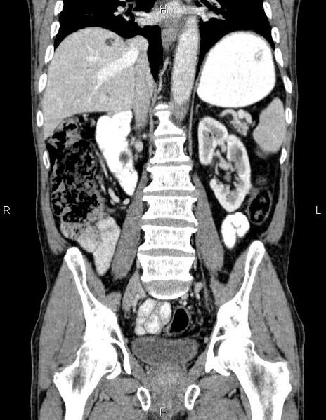 File:Ampullary adenocarcinoma (Radiopaedia 86093-102032 C 41).jpg