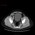 Ampullary carcinoma (Radiopaedia 56396-63056 C 87).jpg