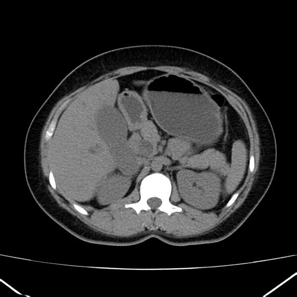File:Ampullary tumor (Radiopaedia 22787-22816 Axial non-contrast 19).jpg