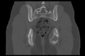 Aneurysmal bone cyst of ischium (Radiopaedia 25957-26094 Coronal bone window 32).png