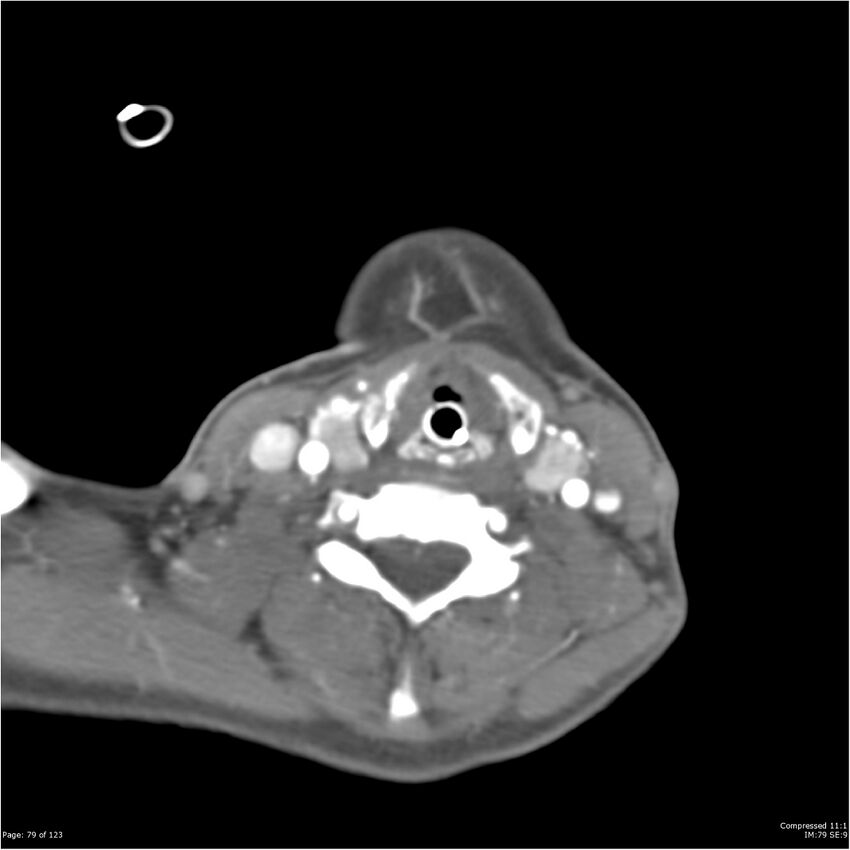 Aneurysmal subarachnoid hemorrhage and Moya Moya disease (Radiopaedia 34306-35593 Axial CT COW 79).jpg