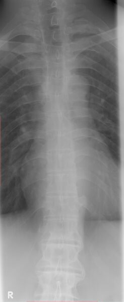 File:Ankylosing spondylitis (Radiopaedia 28993-29347 Frontal dorsal spine 1).jpg