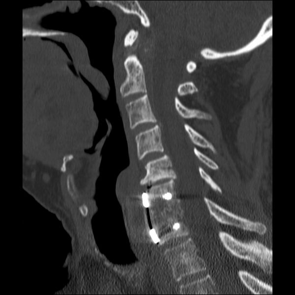 File:Anterior cervical postdiscectomy arthrodesis (Radiopaedia 32678-33646 Sagittal bone window 41).jpg