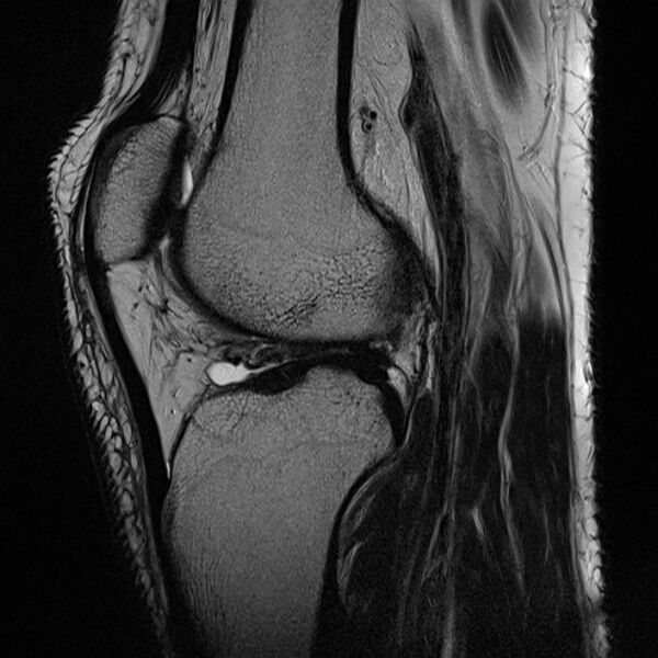 File:Anterior cruciate ligament tear - ramp lesion (Radiopaedia 71883-82322 Sagittal T2 11).jpg