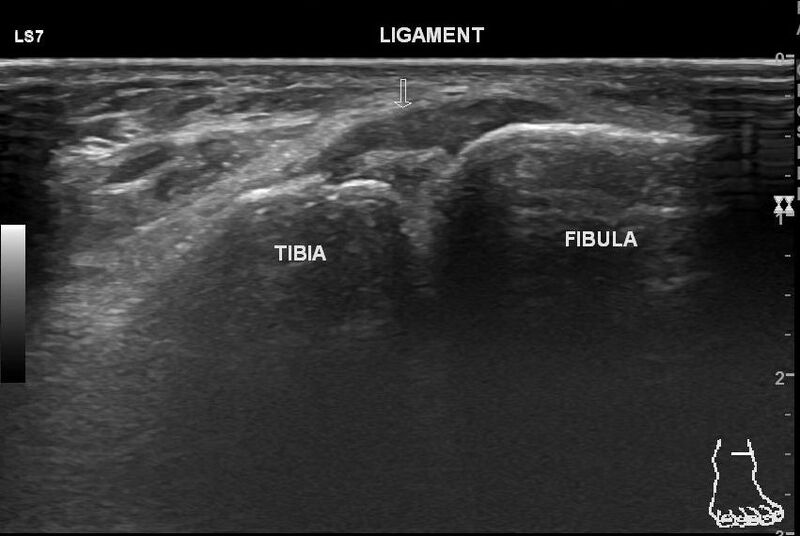 File:Anterior inferior tibiofibular ligament injury (Radiopaedia 65077-74073 Longitudinal 2).jpg