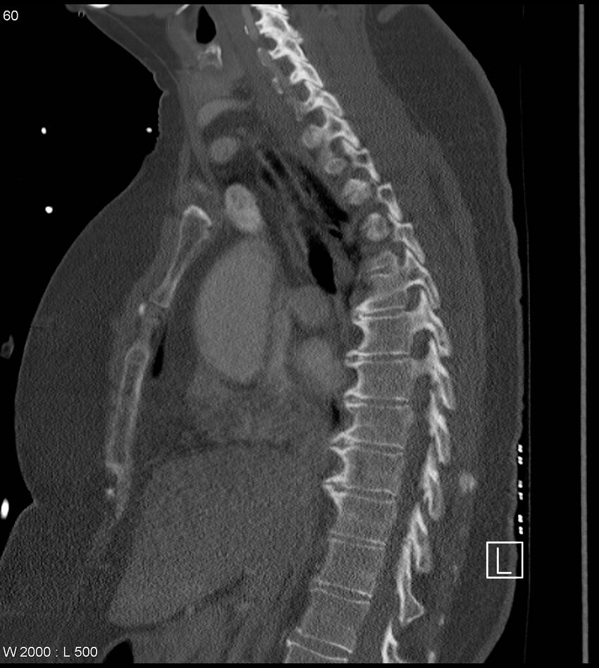 Anterior shoulder dislocation (CT) (Radiopaedia 59032-66309 Sagittal bone window 30).jpg