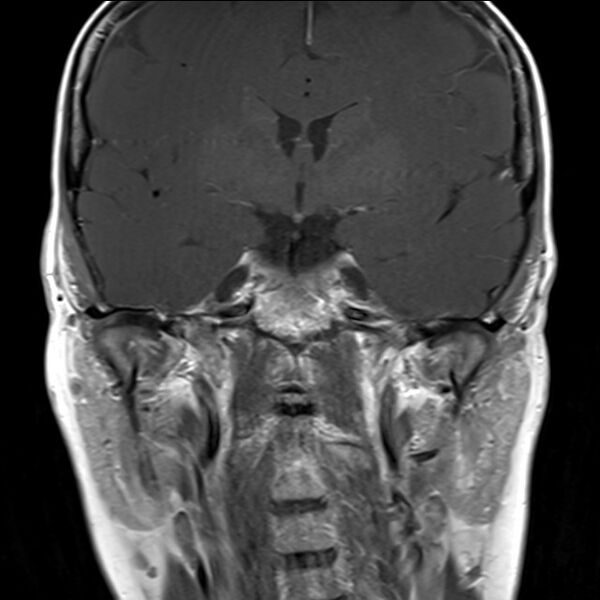 File:Anterior temporal encephalocele (Radiopaedia 82624-96808 Coronal T1 8).jpg
