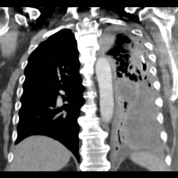 File:Aortic arch false aneurysm (Radiopaedia 14667-14588 B 14).jpg