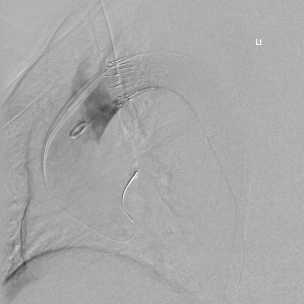 File:Aortic arch false aneurysm (Radiopaedia 14667-14589 Final result 3).jpg