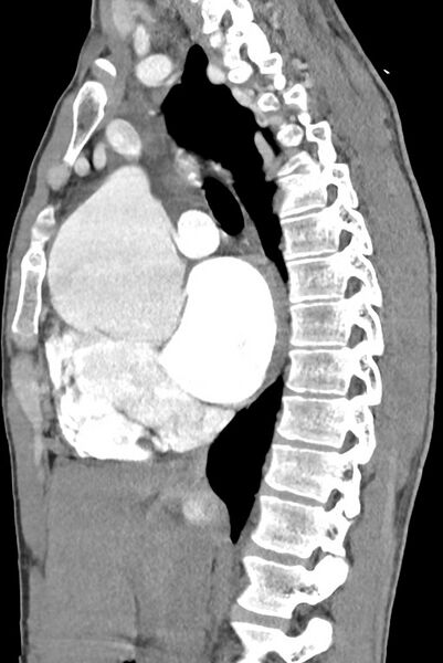 File:Aortic coarctation with aneurysm (Radiopaedia 74818-85828 B 75).jpg