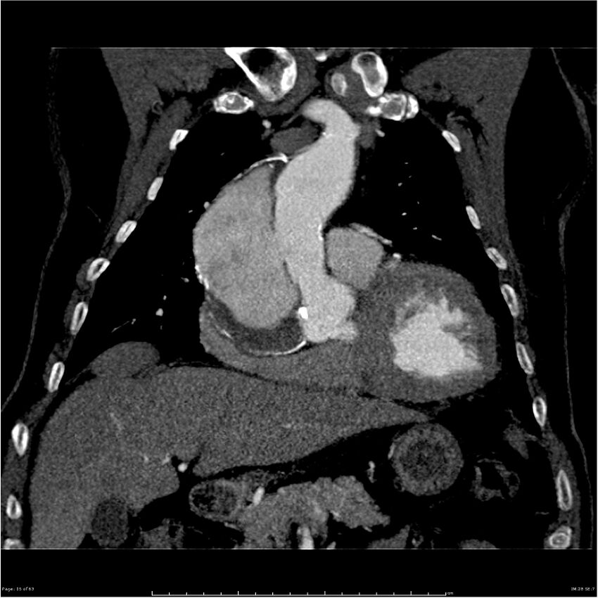 Aortic dissection - Stanford type A (Radiopaedia 26183-26315 A 15).jpg