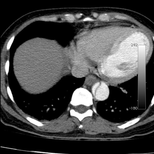 File:Aortic dissection - Stanford type A (Radiopaedia 29247-29659 A 58).jpg