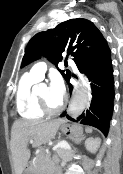 File:Aortic dissection - Stanford type B (Radiopaedia 50171-55512 C 19).png