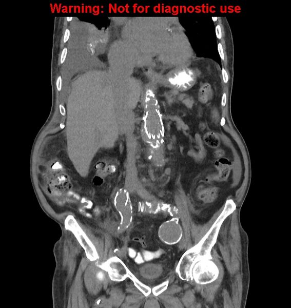 File:Aortic graft infection (Radiopaedia 44979-48907 non-contrast 26).jpg
