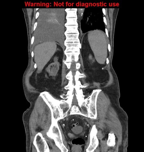 File:Aortic graft infection (Radiopaedia 44979-48907 non-contrast 38).jpg