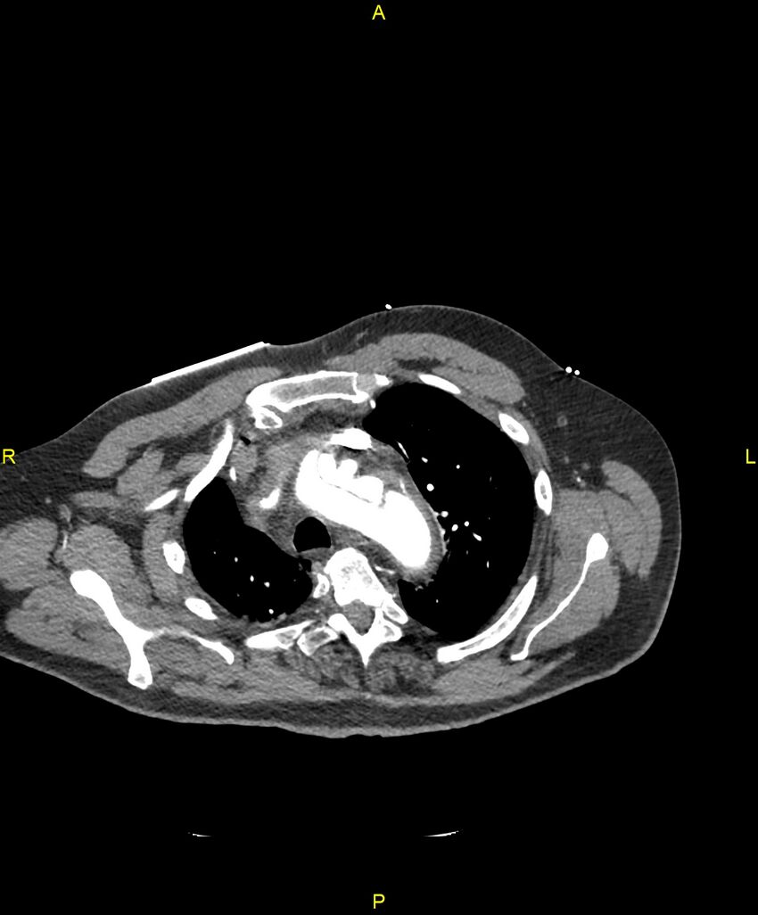 Aortic rupture (Radiopaedia 88822-105594 B 54).jpg