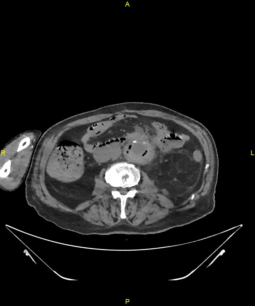 Aortoenteric fistula (Radiopaedia 84308-99603 Axial non-contrast 186).jpg